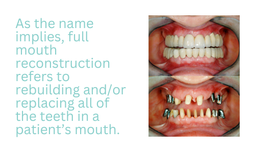 As the name implies, full mouth reconstruction refers to rebuilding and/or replacing all of the teeth in a patient’s mouth.