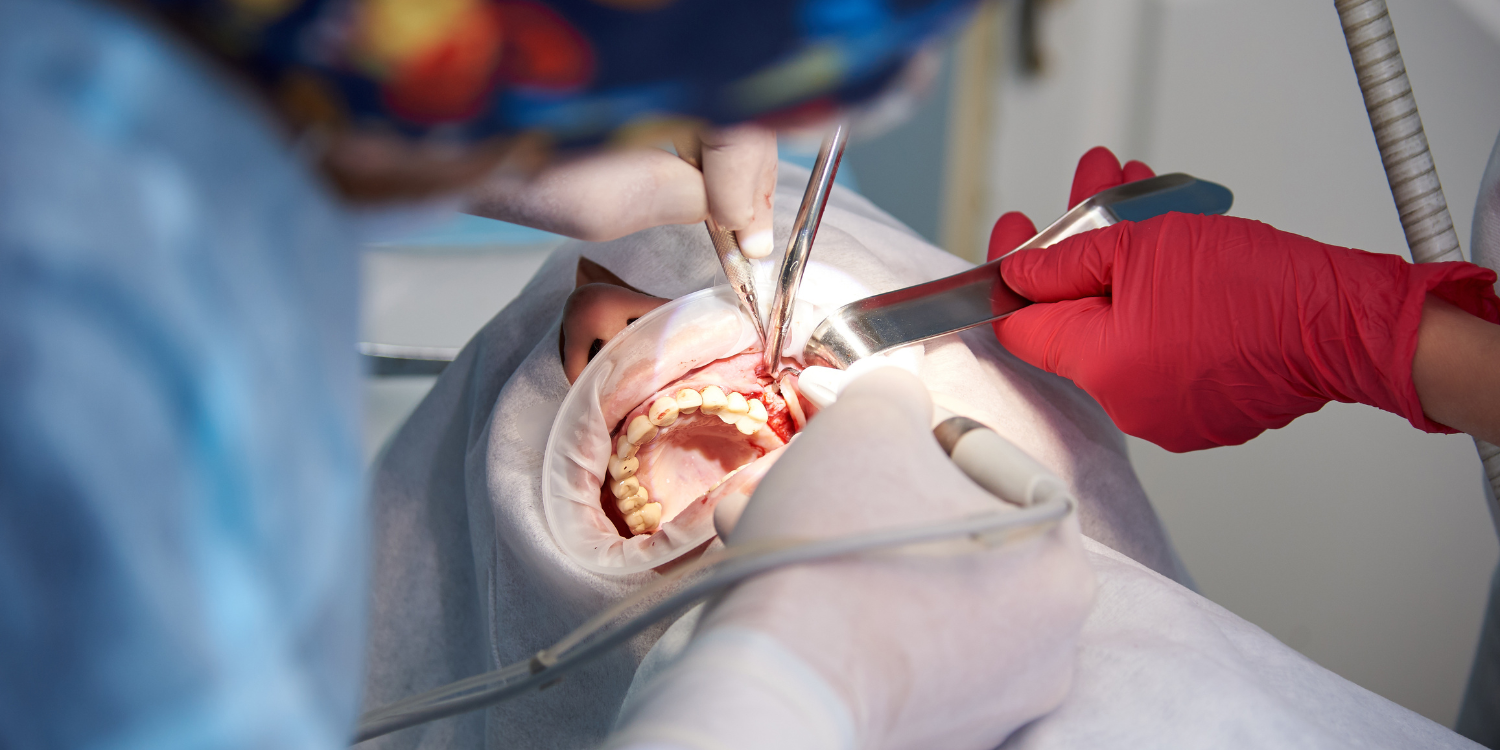 Bone Grafting The Wisdom Teeth Guru Dr. Kiet Tran