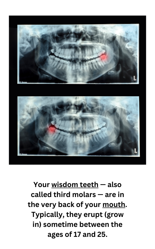 Your wisdom teeth — also called third molars — are in the very back of your mouth. Typically, they erupt (grow in) sometime between the ages of 17 and 25.