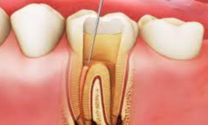 Remove a nerve from a tooth