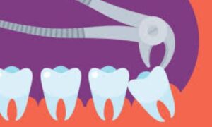 Discover the post-operative journey of wisdom teeth removal with insights on what to expect. Get answers to FAQs and expert advice on After Wisdom Teeth Removal.