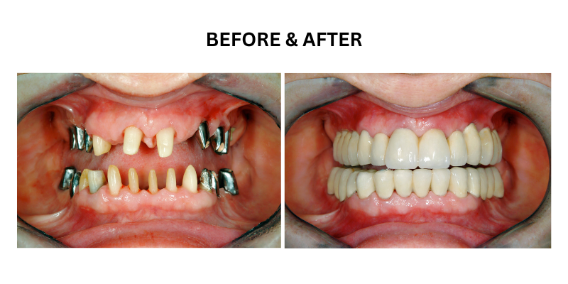 Full mouth reconstruction before and after