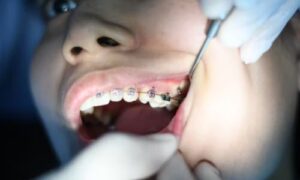 Learn about the complications and risks associated with wisdom teeth extraction. Find answers to frequently asked questions and...