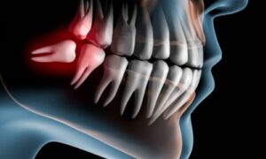 Welcome to a comprehensive guide on how wisdom teeth can affect your smile. While these teeth are a natural part of the human dental anatomy,