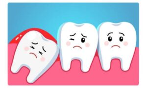 Are you curious about Wisdom Teeth Myths and Facts? Discover the truth behind common misconceptions, with expert insights and FAQs.