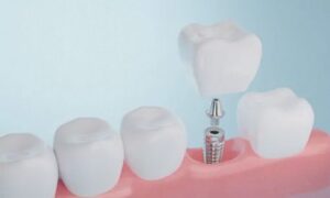 Let's delve into this guide to demystify everything you need about dental implants, including crucial tips for a successful journey.